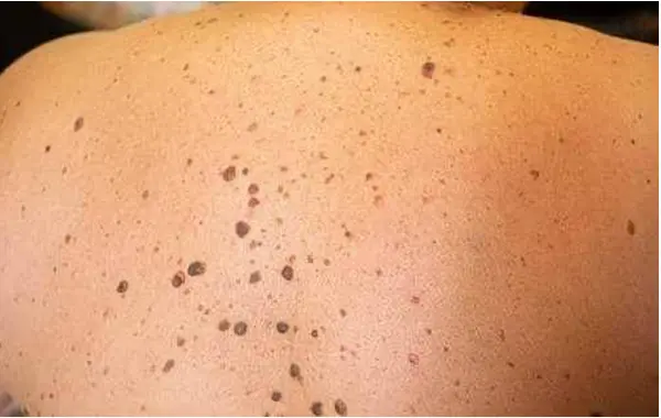 Спина покрытая папилломами