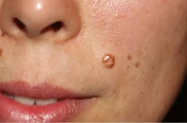 Крупный план папиллом на коже