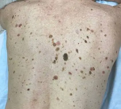 Фото спины с папилломами