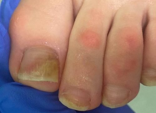 Симптомы грибка на ноге