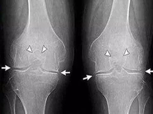 Восстановленные суставы