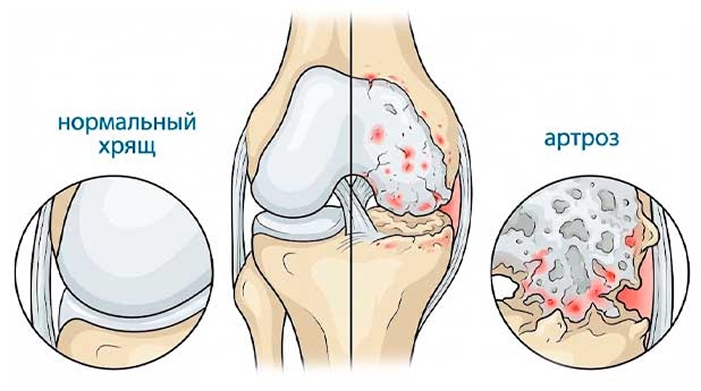 Проблемы с суставами