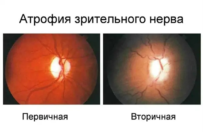 Изображение глазных болезней